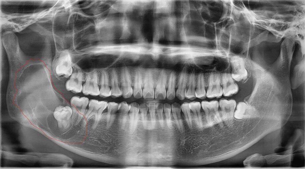 Tưởng mọc răng khôn hóa khối u trong miệng